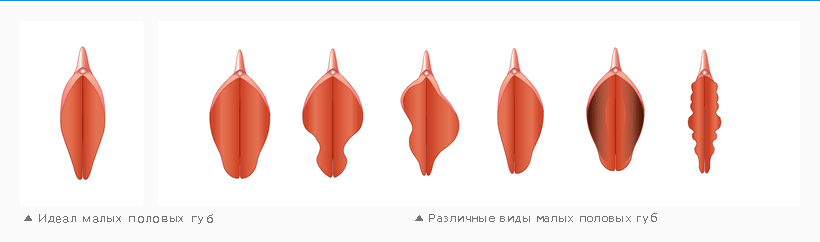 Резекция половых губ, V-образная резекция малых половых губ
 Форма Половых Губ