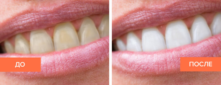 Фото до и после отбеливания зубов