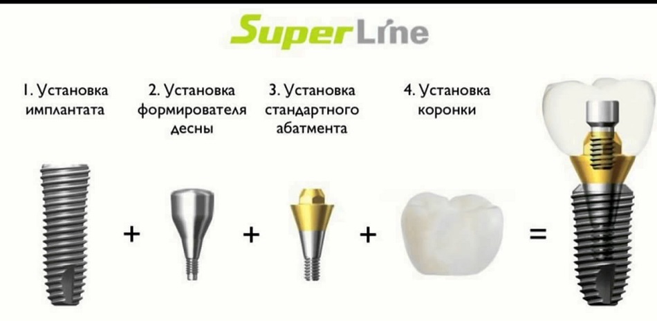 Установка импланта Dentium Superline