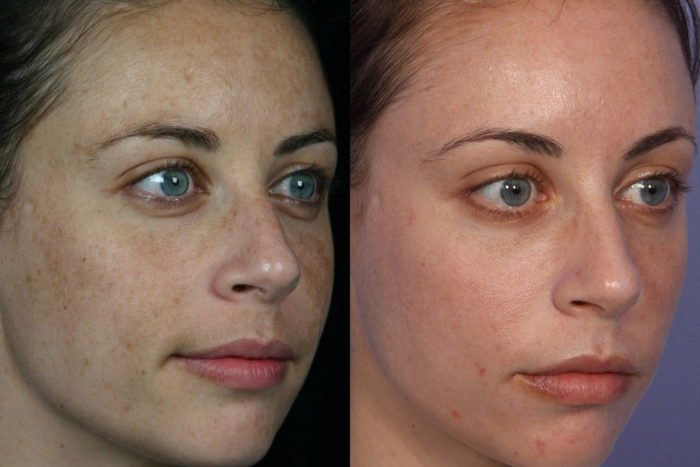 Лазерная омоложение лица фото до и после