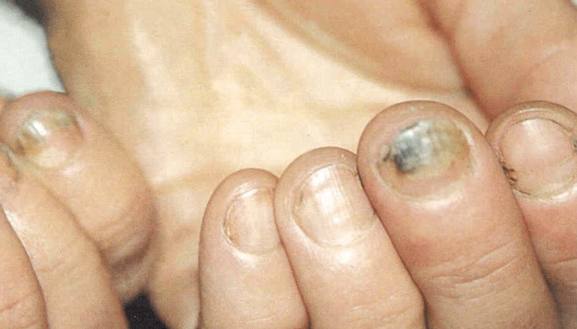 какие заболевания ногтей на руках бывают описание и фото