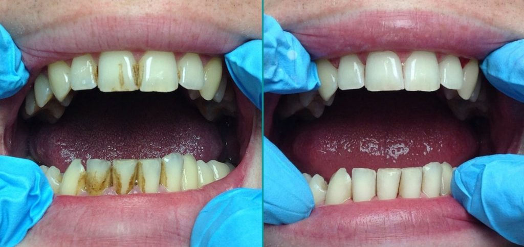 Механическая чистка зубов фото до и после