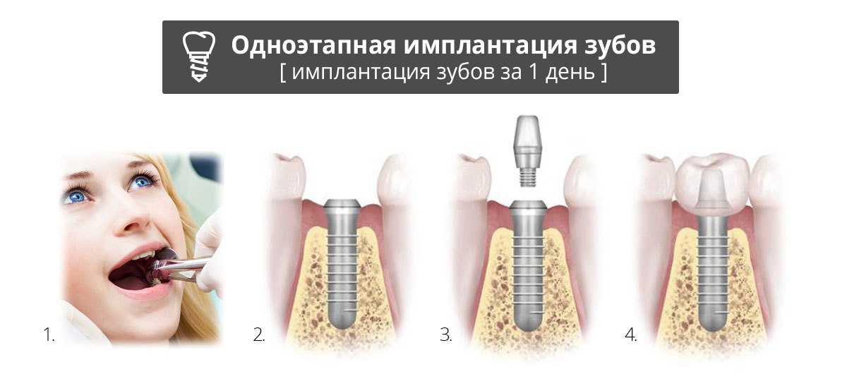 Одноэтапная имплантация зубов 
