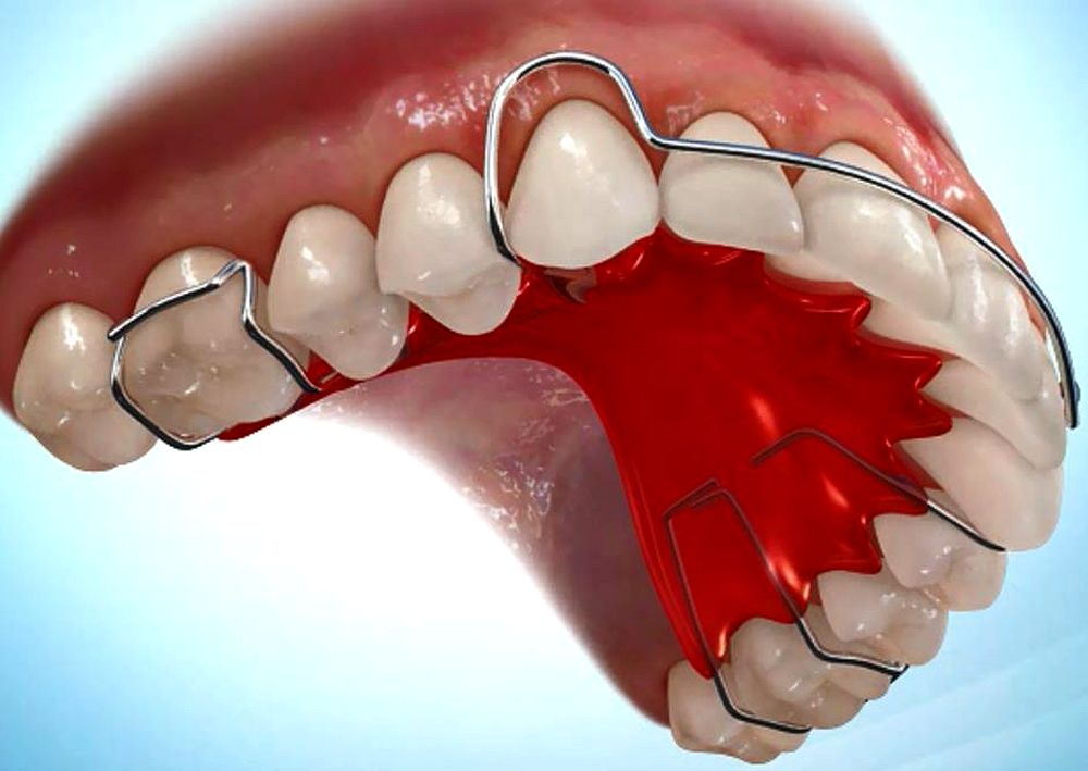 Ортодонтические пластинки несъемные