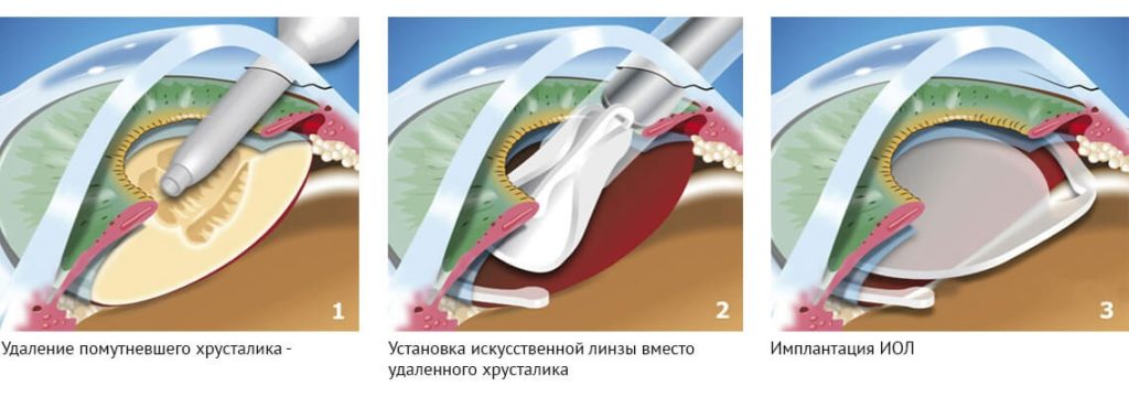 Операция факоэмульсификации катаракты этапы
