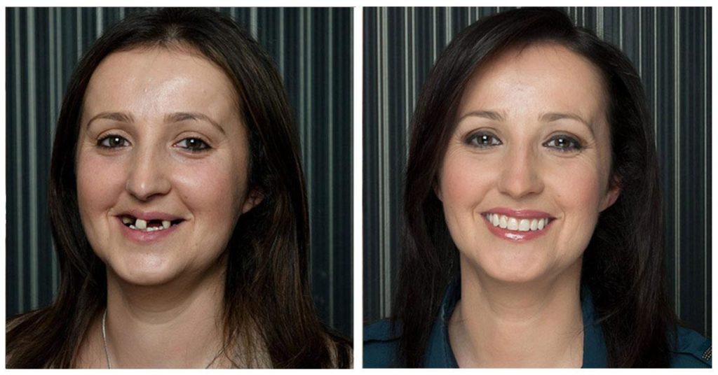 фото до и после протезирования зубов на 4 имплантах