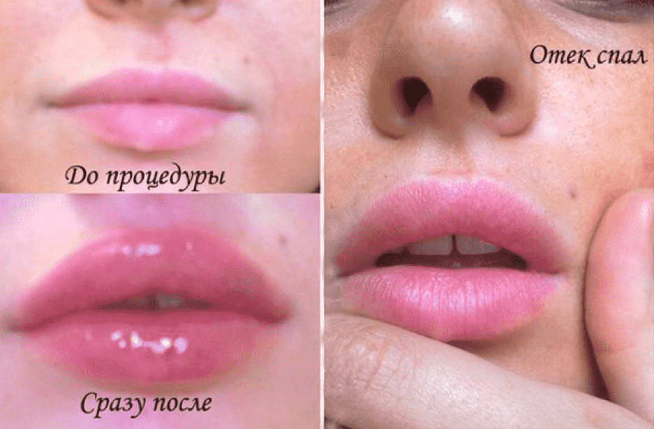 Увеличение губ филлерами фото до и после