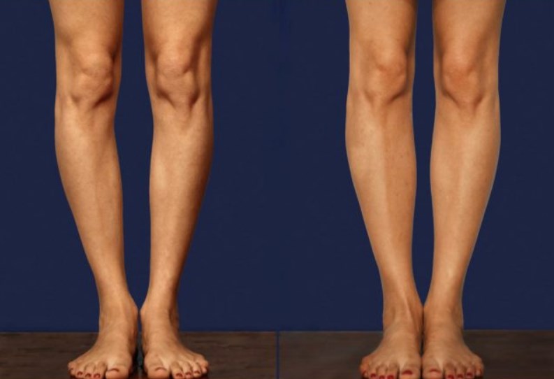 Круропластика ног