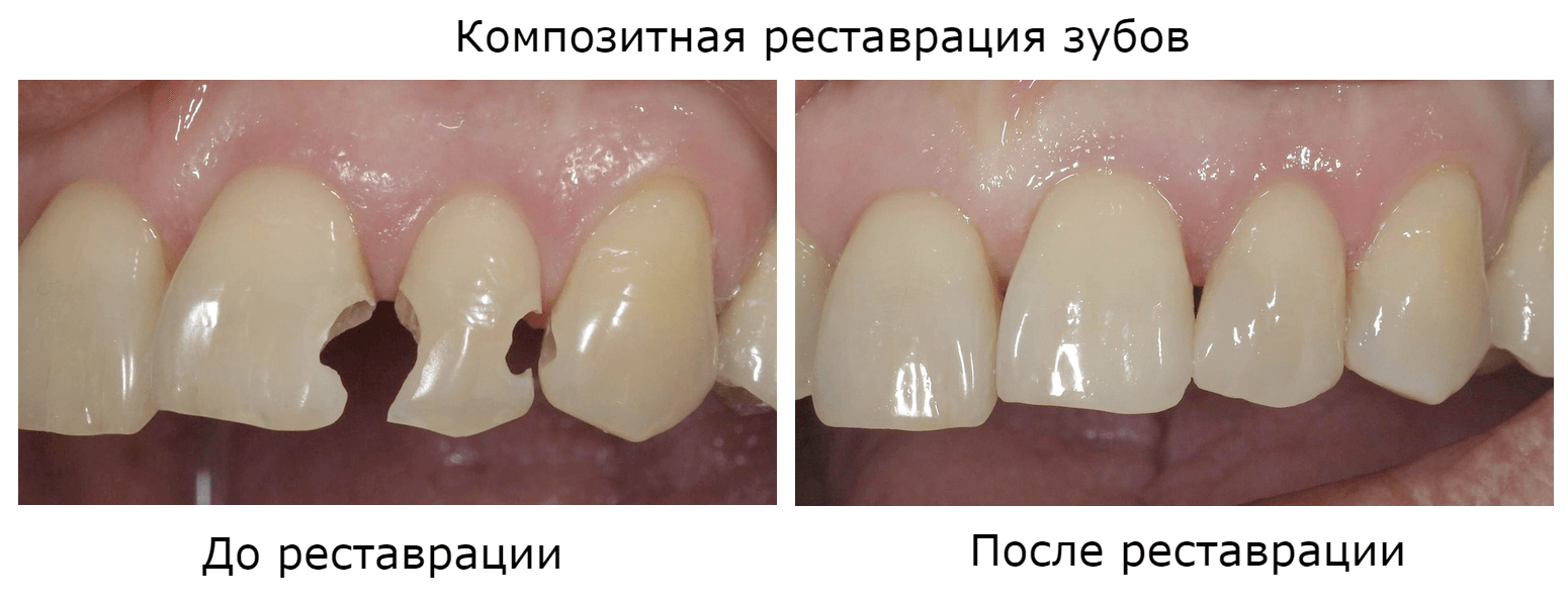 поврежденный зуб фото