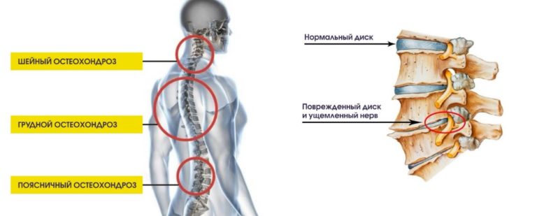 Остеохондроз причины заболевания компьютер