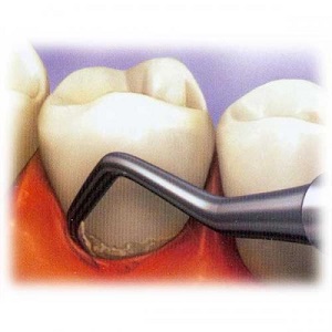 Механическая чистка зубов