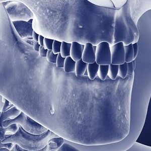 Остеомиелит челюсти – причины, симптомы, лечение