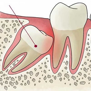 Удаление сверхкомплектного зуба