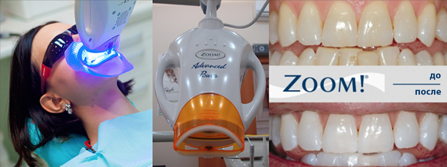 Отзывы про отбеливание зубов zoom отбеливание зубов определение