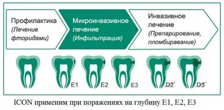 Лечение кариеса Томск Революционный удаление зуба томск