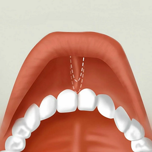 пластике уздечки верхней губы